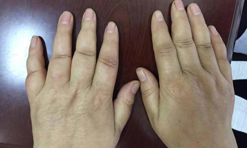 (图:罗女士手部类风湿症状明显)