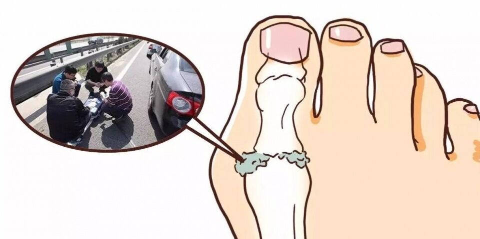 生活中注意这6点,痛风自然一天天好起来